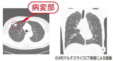肺ドック
