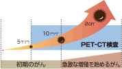 小さながんも発見！