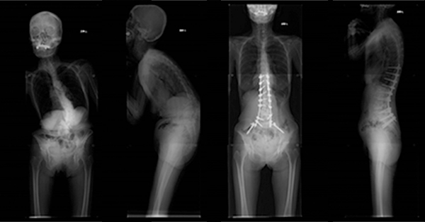 成人脊柱変形のレントゲン