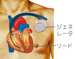 ペースメーカー