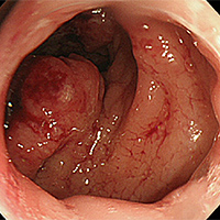 直腸がん1