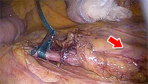 直腸がんの実際の手術の写真1