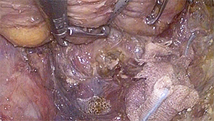 直腸がんの実際の手術の写真2