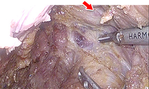 直腸がんの実際の手術の写真2