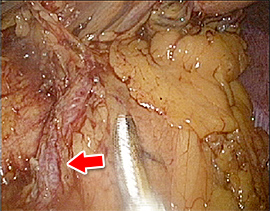 腹腔鏡下噴門側胃切除の実際の手術の写真1