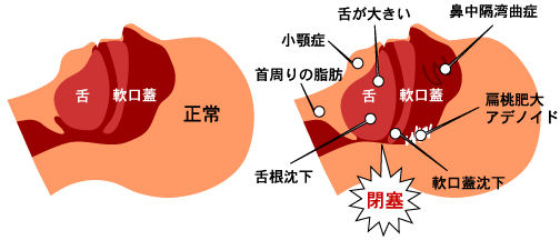 正常な喉と喉が狭くなっている喉