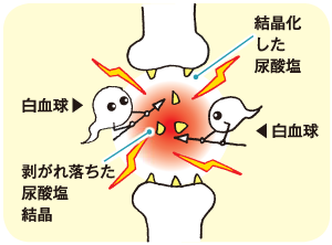 痛風の図説