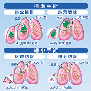 標準手術 縮小手術