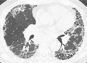 特発性肺線維症の胸部CT所見