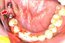 インプラント一次手術