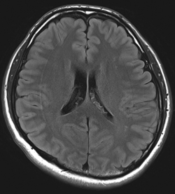 1.5T-MRIで撮影した脳（FLAIR）