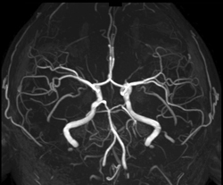 1.5T-MRIで撮影した脳血管（MRA）