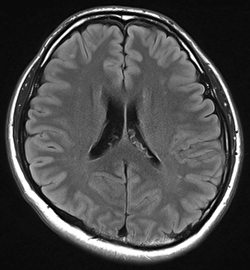 3T-MRI装置で撮影した脳（FLAIR）