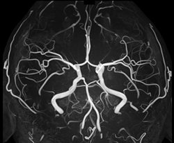 3T-MRI装置で撮影した脳血管（MRA）