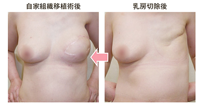 乳房切除後→自家組織移植術後
