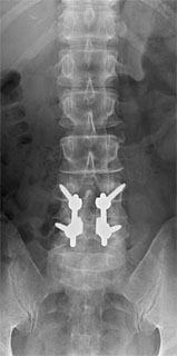 再発性L4／5腰椎椎間板ヘルニア 症例