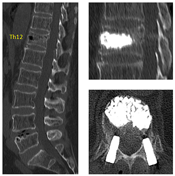 第12胸椎椎体形成術