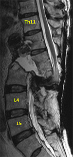 第2腰椎後方脱臼骨折後偽関節 症例