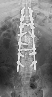 第2腰椎後方脱臼骨折後偽関節 症例