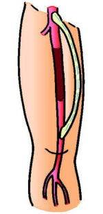大動脈-膝窩動脈間バイパス術