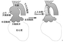 正常腹部大動脈（左）と腹部大動脈瘤