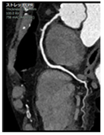 冠動脈CT検査画像