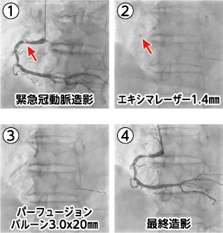 エキシマレーザー冠動脈形成術の症例図説