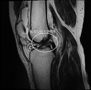 正常な前十字靭帯