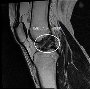 断裂した前十字靭帯