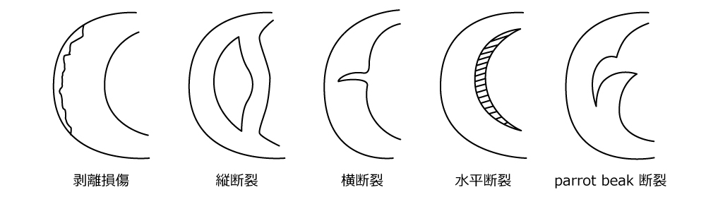 半月板損傷の分類
