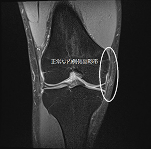 正常な内側側副靭帯