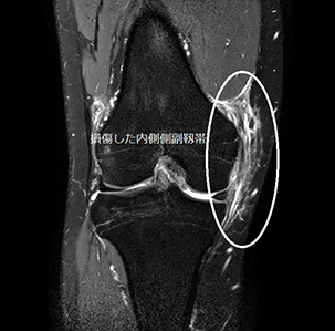損傷した内側側副靭帯