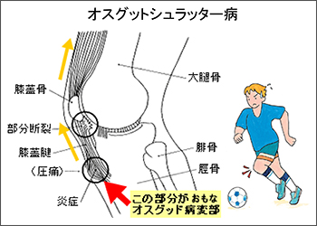 オスグットシュラッター病