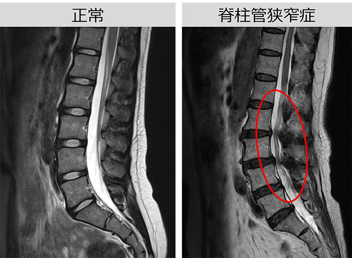 正常な骨と腰部脊柱管狭窄症の骨