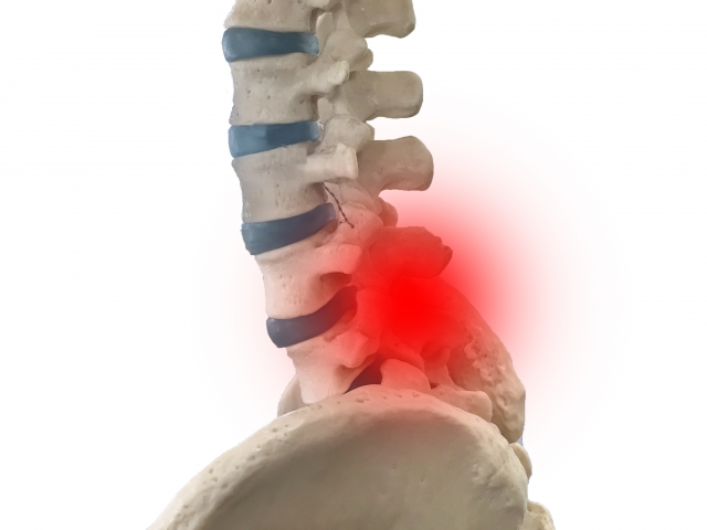 腰椎分離症・分離すべり症