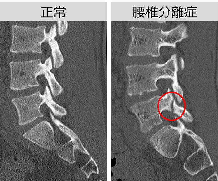 正常な骨と腰椎分離症・分離すべり症の骨