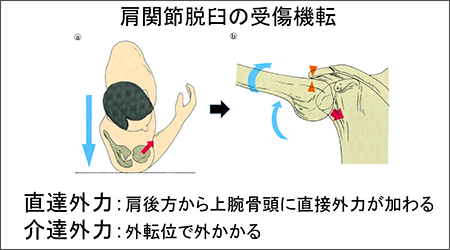 肩関節脱臼の受傷機転