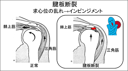 腱板断裂