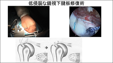 低侵襲な鏡視下腱板修復術