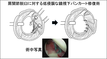 肩関節脱臼に対する低侵襲な鏡視下バンカート修復術