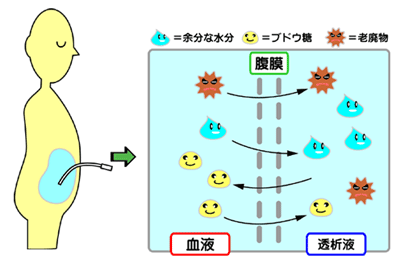 CAPDのしくみ