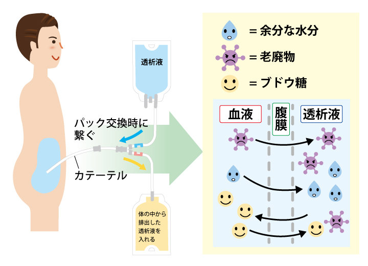 CAPDとは