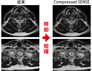 従来とCompressed SENSEの画質比較