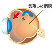 剥離した網膜