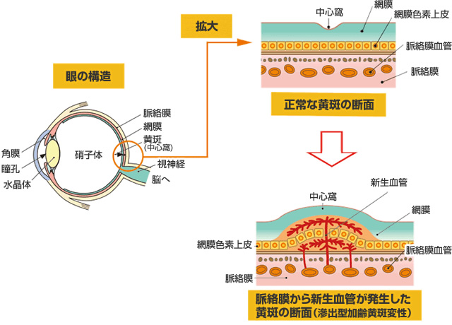 加齢黄斑変性の症状