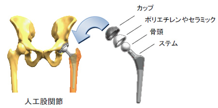 人工股関節