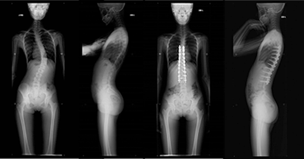 特発性側弯症のレントゲン