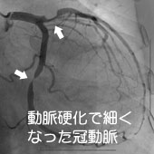 動脈硬化で細くなった冠動脈