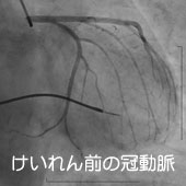 けいれん前