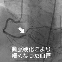 動脈硬化により細くなった血管